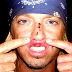 bret-michaels-broken-nose1